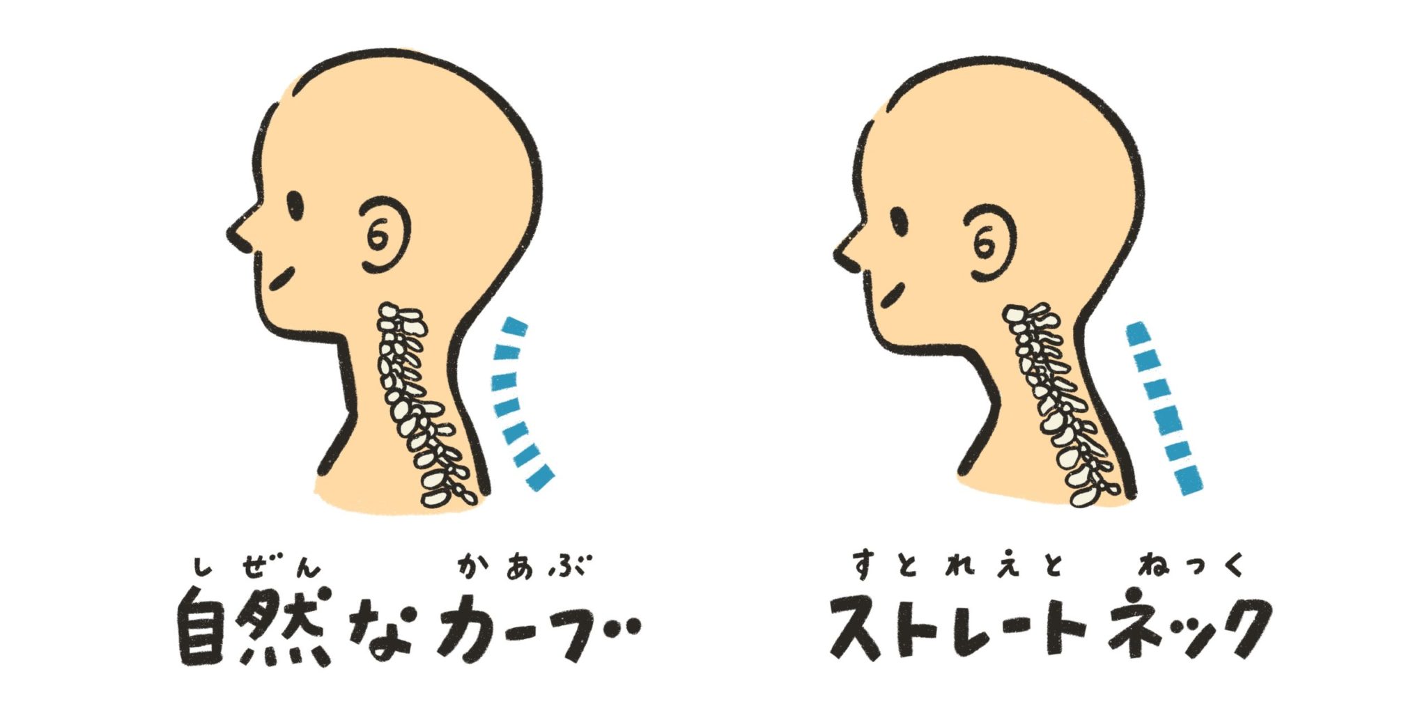首が太いのは気のせい？もしかしたらストレートネックで首がむくんでいるのが原因かも？ | 茨木市 まつお鍼灸整骨院